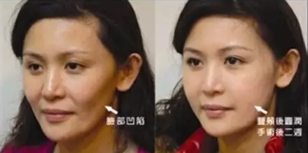 奶茶妹妹才24岁,竟然就出现了笑肌断层!
